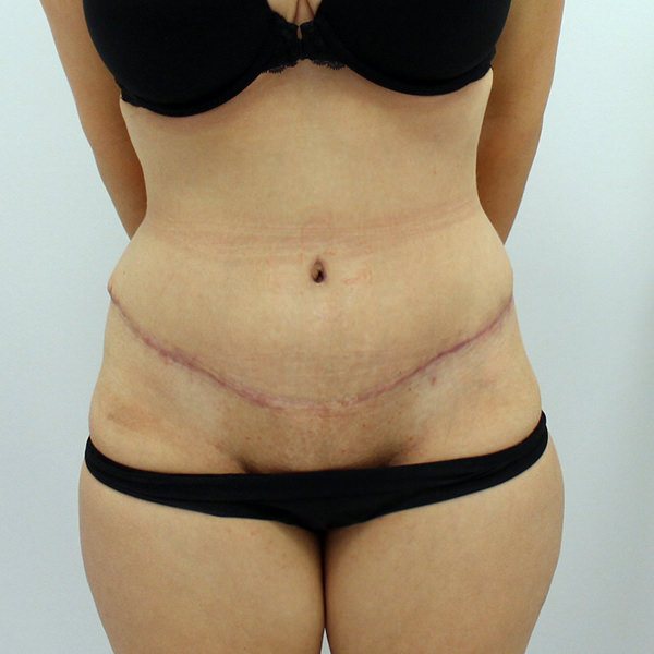 Fleur de Lys Abdominoplasty  The Cosmetic Surgery Clinic