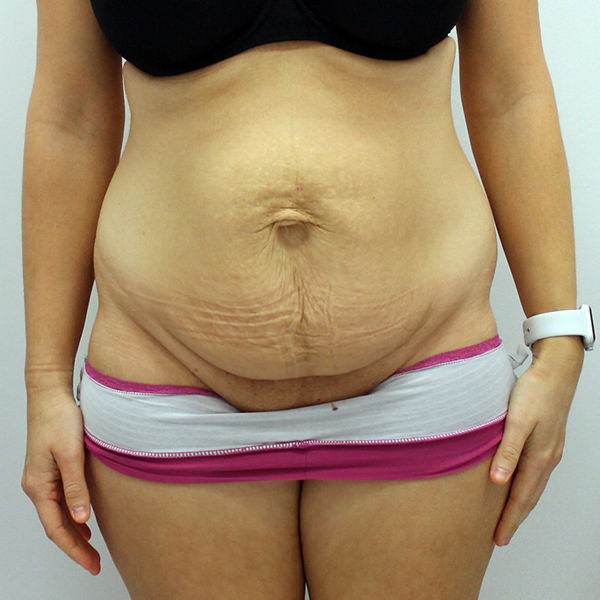 Circumferential Tummy Tuck/Lower Body Lift Photo Gallery – Dr John Burns