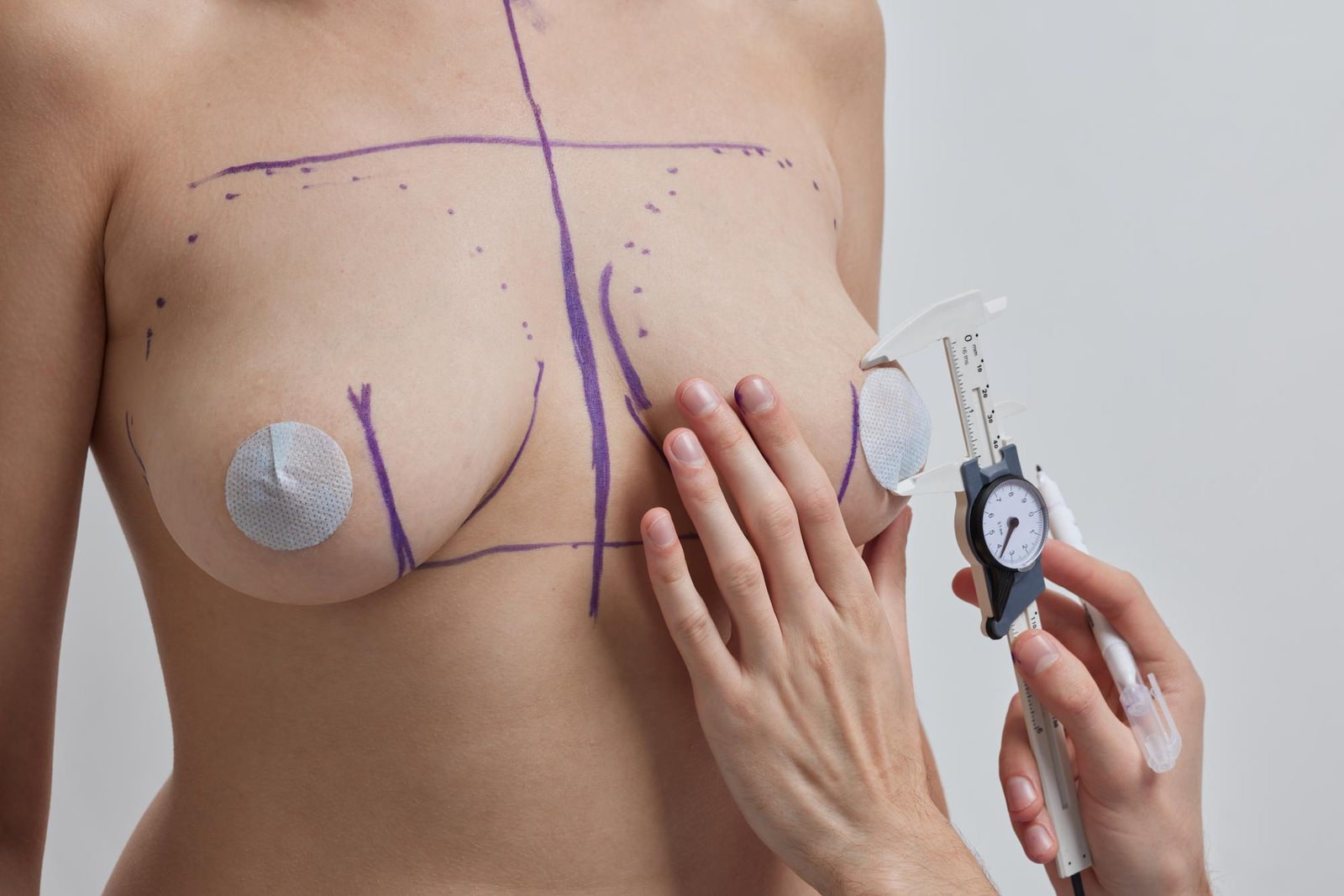 Areola Reduction Surgery
